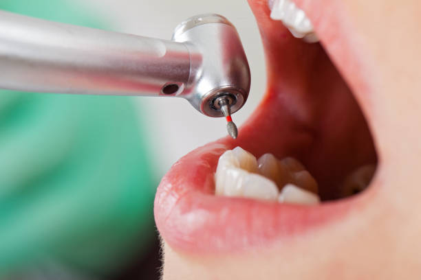 Best Knocked-Out Tooth (Avulsed Tooth) Treatment in Hooverson Heights, WV